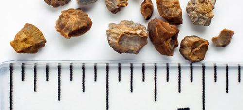 Gene mutation found causing kidney stones